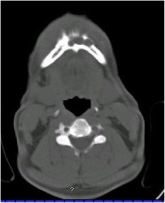 Figure 3: Photograph showing CT scan showing an osteolytic lesion with buccal and lingual cortical perforations in the symphysis region.